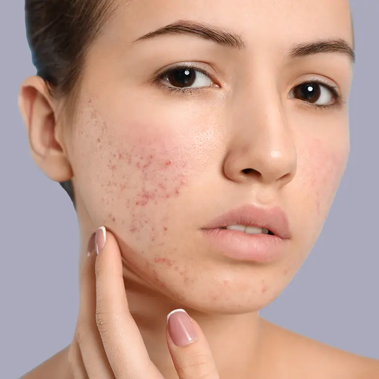 Marion Brown - Dermatology - Acne Care