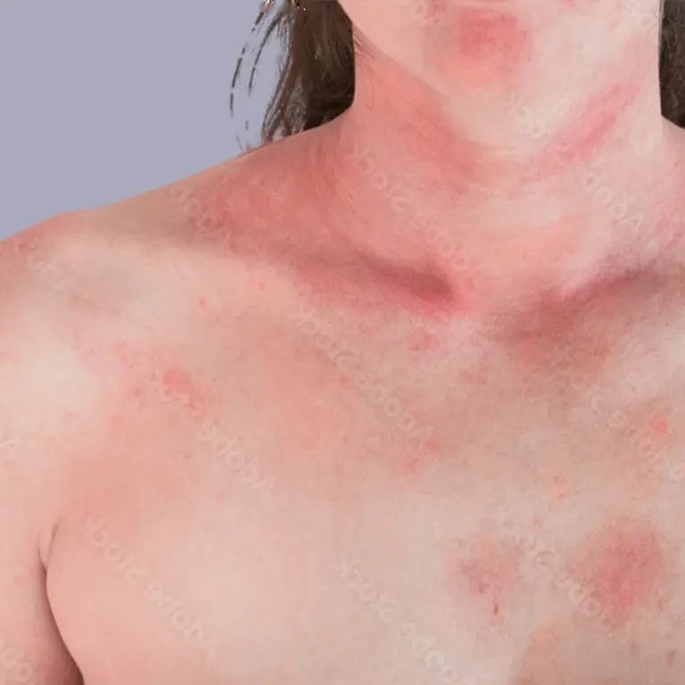 Dermatology Eczema