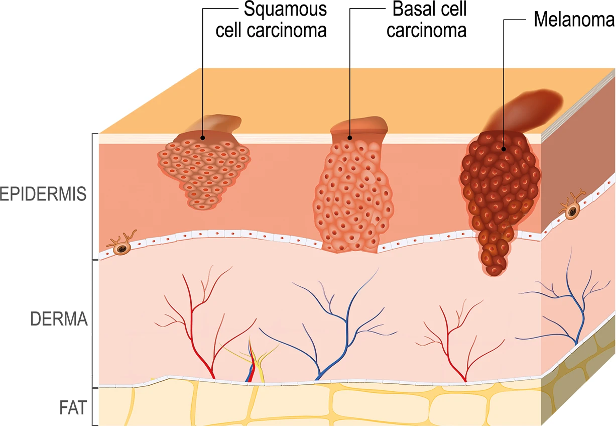 Skin Cancer Diagram